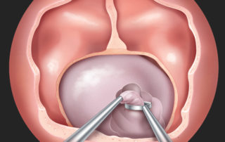 Removal of a macroadenoma. The approach to a larger tumor is similar to that of a microadenoma except for more extensive removal of bone over the cavernous and superior intercavernous sinuses. This permits lateral and superior reflection of these sinuses, respectively, for better visualization of tumor along the medial walls of the cavernous sinus and in the suprasellar cistern. First, the central mass of the tumor is reduced by suction or ring curettage.