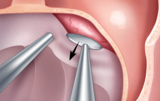 Tumor is then removed from the sella floor and then up along the medial walls of the cavernous sinuses. Often, tumor that appeared to be within the cavernous sinus on preoperative imaging is found to have displaced a distended but intact medial wall laterally and thus can be removed without opening into the cavernous sinus.