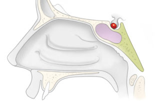 Pituitary microadenoma: sagittal view.