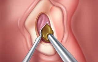 Incision of the cyst wall and evacuation of its contents. To avoid possible stenosis of the drainage portal, the widest possible marsupialization should be created.