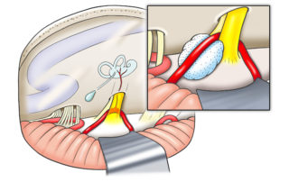 Overview of microvascular decompression of the facial nerve. Inset shows a sponge separating the vessel from the facial nerve.