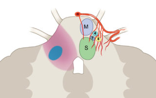 The impact of anterior inferior cerebellar artery (AICA) injury on neighboring cranial nerve nuclei, motor, and sensory tracts. Cross-sectional view of the brain stem for comparing proximal versus distal AICA injury and the resultant area of ischemia. Interruption of the distal branches of AICA results in a much more focal infarction that typically does not extend to the 4th ventricle. (M, motor tracts; S, sensory tracts; 4, abducens nerve; 5, trigeminal nerve; 7, facial nerve; 8, audiovestibular nerve; IAA, internal auditory artery.)