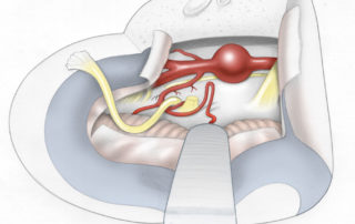Surgical view of a midbasilar artery aneurysm, above the takeoff of anterior inferior cerebellar artery, via the transcochlear approach. (5, trigeminal nerve; 7, facial nerve; 8, cochlear nerve.)