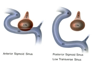 (A) The anatomical positioning of the sigmoid sinus is variable. In the translabyrinthine approach, an anteriorly placed sigmoid that approximates the ear canal can be a nuisance during the early portion of the craniotomy. Nevertheless, with an appropriate amount of retrosigmoid bone removal, sufficient sigmoid mobilization is routinely obtained even with the most disadvantageous sinus positioning. In the retrosigmoid approach, an anteriorly placed sigmoid sinus actually reduces the depth of exposure and lessens the need for cerebellar retraction. (B) A posteriorly placed sigmoid sinus, particularly when accompanied by a low-lying transverse sinus, is a hindrance in the retrosigmoid approach, which results in a deep operative field and increases the need for cerebellar retraction. When the patient’s neck is short or of limited mobility, a posteriorly placed sigmoid may force the surgeon to work at an awkward angle. (IAC and CPA, internal auditory canal and cerebellopontine angle components of an acoustic neuroma; JB, jugular bulb; SS, sigmoid sinus; TS, transverse sinus; SPS, superior petrosal sinus.)