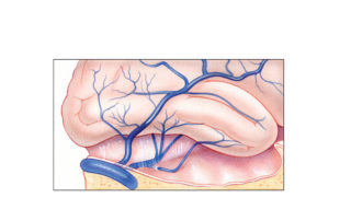 Inferior anastomotic vein of Labbé (thin arrows) as seen from a lateral perspective after elevation of the temporal lobe. In many cases, it represents the primary venous drainage of the temporoparietal region. While Labbé is usually the dominant vein bridging between the cortical surface and the transverse-sigmoid system, other more variable anastomotic veins may egress the inferior surface of the temporal lobe and enter the tentorium (thick arrow). These travel as a tentorial sinus and ultimately enter the transverse sinus either directly or after joining Labbé en route.