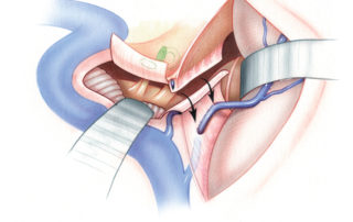 Following division of the superior petrosal sinus in proximity to the labyrinth, the tentorium (T) is divided. It is important that the tentoriotomy be directed medially to reach the incisural notch (thick arrow). It is tempting to divide the tentorium along a line parallel to the petrous bone, but this is an error as it directs the incision towards the roof of Meckel’s cave and the cavernous sinus rather than to the free edge of the tentorium. (L, vein of Labbé; TL, temporal lobe.)