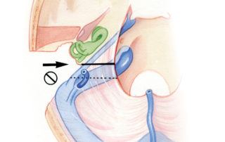 A more anteriorly placed line of tentorial division (arrow, solid line) better avoids the vein of Labbé than the earlier described more posterior technique (circle with line, dashed line).