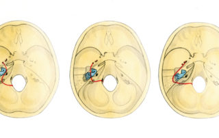 Possible courses of transverse temporal bone fractures: In its course from the foramen magnum to the floor of the middle fossa the transverse fracture may pass either lateral to, through or medial to the otic capsule. The most common path is directly through the otic capsule, thereby disrupting the inner ear (B). In the rare case where the fracture spares the otic capsule by passing medial to it (A), the facial and vestibulocochlear nerves are at risk as the fracture traverses the internal auditory canal. Also rare, the fracture spare the otic capsule by passing lateral to it through the middle ear (C).