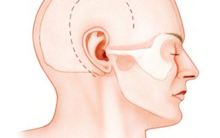 The incision (dashed line) used to expose the entire intratemporal facial nerve after injury due to cranial base fracture is curvilinear, providing access to both the temporal fossa and mastoid regions.