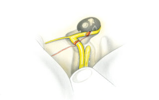 The most frequent site of injury in temporal bone fractures is the geniculate ganglion region as shown here via the middle fossa approach. The nerve is most often merely contused, but it may also be partially lacerated, or even transected as depicted here. Note that the fracture line traverses both labyrinthine and upper tympanic segments of the nerve. Note that the incus body has become displaced from the malleus head, a common complication of longitudinal temporal bone fractures.