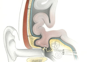Encephaloceles of the temporal bone most commonly occur through the floor of the middle cranial fossa into the epitympanum or mastoid. Most frequently, they are traumatic in origin, arising either due to cranial base fracture or after iatrogenic injury sustained during mastoid surgery. Spontaneous meningoceles and encephaloceles also occur, presumably due to prominent arachnoid granulations that penetrate the eggshell-thin tegmen mastoideum or tympani. Chronically increased intracranial pressure may play a role in such cases.