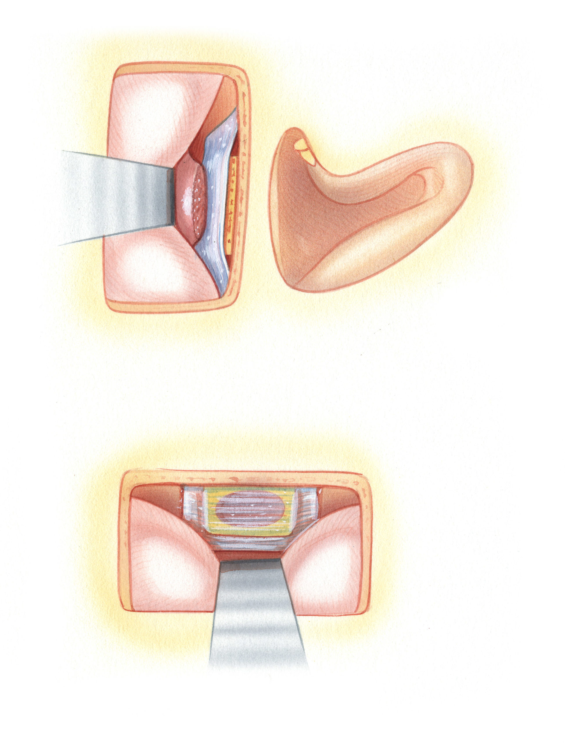Narrow deficiencies in the temporal floor can be repaired with a soft tissue graft alone. Wider defects should be bridged by a bone graft, as depicted here, in addition to a connective tissue sheet.