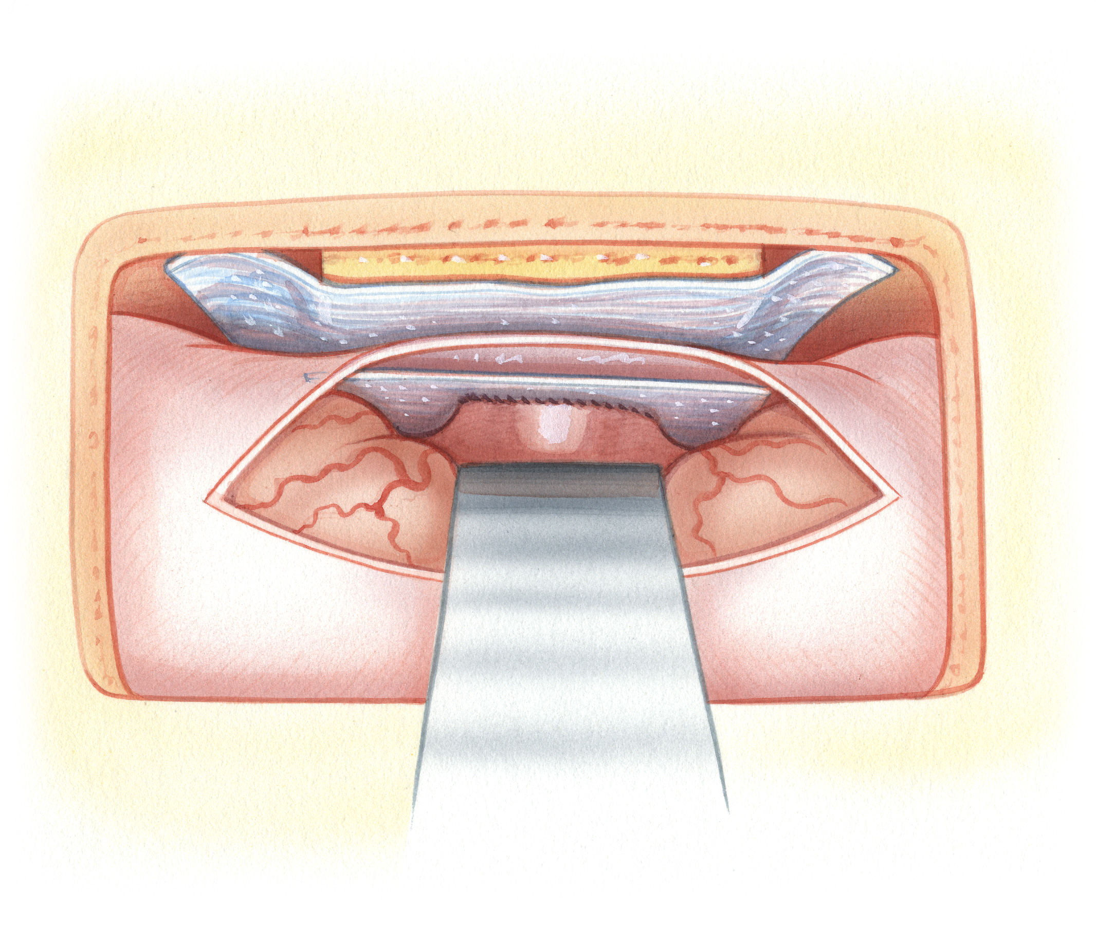 When the dural defect is large, placing a supplemental fascia graft intradurally is desirable. The advantage of an intradural graft is that the weight of the brain helps to coapt the graft with the surrounding dura.