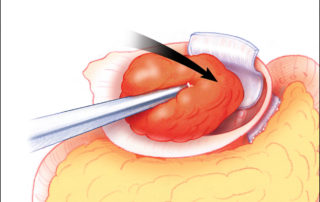 A free graft of temporalis muscle is mortised into the medial ear canal to obliterate the middle ear cavity and hold the fascia in place over the eustachian tube orifice.