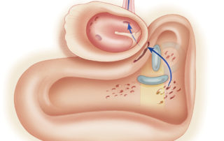 The pathway (arrows) of cerebrospinal fluid leakage from the mastoid into the middle ear.