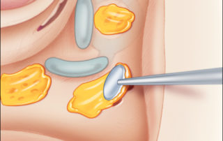 In a hearing ear, the perilabyrinthine cell tract can be meticulously sealed with bone wax.