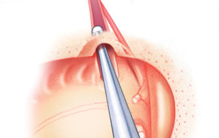 A diamond burr is used to funnel the middle ear orifice of the eustachian tube.