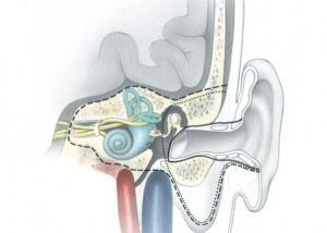 Temporal bone resection for malignancy encompasses three related procedures of progressively increasing depth: sleeve resection of the external auditory canal (solid line), lateral temporal bone resection (dotted line), total temporal bone resection (dashed line). The illustration depicts these procedures in the coronal view. Most of these resections are performed for squamous cell carcinoma arising from the external auditory canal. It is generally acknowledged that sleeve resection is insufficient therapy for malignant disease. In the lateral temporal bone resection, the ear canal is removed en bloc with the tympanic membrane and lateral ossicles. A parotidectomy and/or neck dissection often supplements the temporal bone specimen. In total temporal bone resection, creation of an en bloc specimen is difficult and probably unnecessary. It requires an extensive dissection of the intrapetrous carotid artery, a measure usually of little benefit in deeply invasive squamous cell carcinoma. Most contemporary otologists perform the so-called total temporal bone resection by first carrying out a lateral temporal bone resection and then removing the medial petrous bone piecemeal with a drill. This procedure is indicated for deep extension which penetrates beyond the medial wall of the middle ear and/or mastoid.