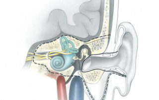 Temporal bone resection for malignancy encompasses three related procedures of progressively increasing depth: sleeve resection of the external auditory canal (solid line), lateral temporal bone resection (dotted line), total temporal bone resection (dashed line). The illustration depicts these procedures in the coronal view. Most of these resections are performed for squamous cell carcinoma arising from the external auditory canal. It is generally acknowledged that sleeve resection is insufficient therapy for malignant disease. In the lateral temporal bone resection, the ear canal is removed en bloc with the tympanic membrane and lateral ossicles. A parotidectomy and/or neck dissection often supplements the temporal bone specimen. In total temporal bone resection, creation of an en bloc specimen is difficult and probably unnecessary. It requires an extensive dissection of the intrapetrous carotid artery, a measure usually of little benefit in deeply invasive squamous cell carcinoma. Most contemporary otologists perform the so-called total temporal bone resection by first carrying out a lateral temporal bone resection and then removing the medial petrous bone piecemeal with a drill. This procedure is indicated for deep extension which penetrates beyond the medial wall of the middle ear and/or mastoid.