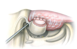 Working between the floor of the middle cranial fossa and the roof of the ear canal, the root of the zygoma is drilled away. It is necessary to continue drilling until the anterior epitympanum has been opened into the glenoid fossa.