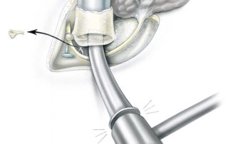After the ear canal has been isolated from above, behind, and below it remains attached only anteriorly. This tenuous bony attachment can usually be cracked by simply pushing the bony canal forward with the surgeon’s thumb. Another option is using a chisel through the facial recess as depicted here.