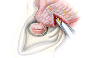 When the anterior aspect of the ear canal is involved by tumor, then it is wise to remove a cuff of tissue anteriorly. This includes part or all of the parotid gland and the tissue which resides between the ear canal and mandibular condyle. Parotidectomy is commenced by identification of the facial nerve as it exits the stylomastoid foramen. In the absence of gross tumor involvement of the parotid region, then only the portion of the gland which abuts the ear canal need be removed. In these cases only the part of the parotid which lies posterior to the upper branch of the facial nerve needs to be included with the specimen.