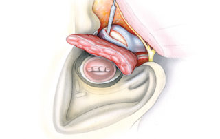 Once the parotid has been reflected posteriorly, the mandibular condyle is addressed. There are three options for handling the condyle: taking only its capsule, partial resection, and complete resection. When leaving the condyle in situ, an incision is made in its capsule with cutting electrocautery.