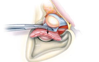 The capsule is then dissected off of the condylar head (ST, superficial temporal artery.)