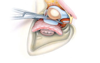 The leathery condylar capsule is transected on its the deep side with Mayo scissors. The superficial temporal artery and vein need to be controlled at this point.