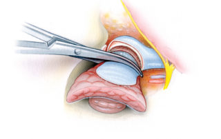 Partial condylectomy can be accomplished with a drill, leaving intact a portion of the articular face of the joint. This maneuver facilitates removal of a wider cuff of soft tissue anterior to the deep portion of the ear canal. Complete condylectomy is accomplished by treading a Gigli saw around the condylar neck. While isolating the condylar neck, care are must be taken to avoid injury to the internal maxillary artery.
