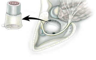 The specimen in a lateral temporal bone resection includes both the cartilaginous and osseous ear canal as well as the tympanic membrane with malleus attached.