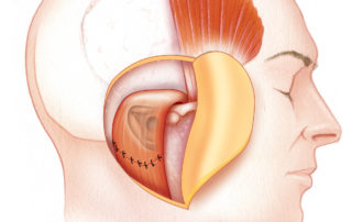 Lateral temporal bone resection may include a resection of the parotid and condylar head in continuity with the ear canal.