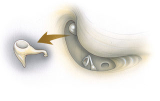 (A). Working via the facial recess, the incudostapedial joint is severed sharply. A disposable myringotomy knife is a convenient tool for accomplishing this maneuver. (B) The bone bridge separating the epitympanum from the facial recess is then drilled away and the incus is removed.