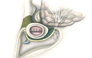 To isolate the ear canal as an en bloc specimen, bone must be removed from 360 degrees around the canal (stippled area). An extended facial recess approach is connected to the posterior and inferior aspects of the middle ear. The front wall of the mastoid is removed between the inferior margin of the osseous ear canal and the stylomastoid foramen. Superiorly, the root of the zygoma and the posterior aspect of the glenoid fossa are removed.