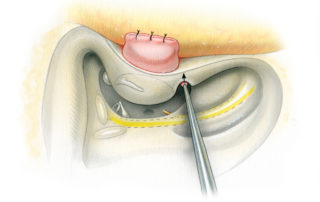 While connecting the facial recess into the hypotympanum, the chorda tympani nerve is sharply transected. Care must be taken while working in this narrow interval to avoid injury to the descending facial nerve with the shaft of the drill. A cut is then made parallel to the bony ear canal through the front face of the mastoid.