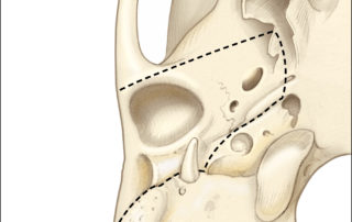 Osseous anatomy of the lateral skull base as seen from below illustrating the resection limits of the infratemporal fossa extension of temporal bone resection (dashed line). (LPP, lateral ptergoid process; FO, foramen ovale; FS, foramen spinosum; G, glenoid fossa; SP, styloid process; C, carotid canal.)