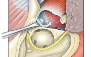 Extended Temporal Bone Resection – Skull Base Surgery Atlas