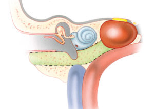 The petrous apex is the medial portion of the petrous bone that lies between the inner ear and the clivus. Petrous apicectomy is the term applied to a procedure which reaches the apical portion of the petrous bone by skirting around the inner ear. It is inherently a drainage procedure which creates only a relatively small entry into the apical region. Thus, the commonly used term petrous apicectomy is a misnomer when used in this context. Petrous apicotomy would actually be a more accurate description for the procedure. Petrous apicectomy is primarily indicated for drainage of cholesterol granuloma and purulent infections. Fundamentally, there are two routes used to reach the petrous apex: those which pass near the labyrinth and those which skirt the cochlea. In recent years, the hypotympanic - subcochlear route depicted here has become the most popular. The bone removed during this procedure is depicted in this schematic coronal illustration as the color green. Note the relationship of the apical cholesterol granuloma to the fifth and sixth nerves. This explains the frequent occurrence of deep ear and retro-orbital pain as well as diplopia in these lesions. (JV, jugular vein; CA, carotid artery; CG, cholesterol granuloma; 5, trigeminal nerve; 6, abducens nerve.)