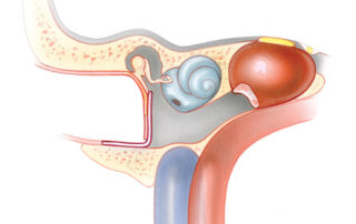 Coronal schematic view of the bone removed during the subcochlear approach to the petrous apex. Note that the floor of the ear canal and hypotympanum has been removed to the level of the jugular bulb. Superiorly, the opening is bounded by the cochlea. More medially, the opening courses over the genu of the carotid artery. As shown here, the hypotympanic defect is enclosed with a fascia graft, resulting in a larger than normal tympanic membrane.