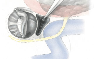 To approach the petrous apex, bone is excavated from the triangle bounded by the cochlea (C) superiorly, the jugular bulb (JB) posteriorly, and the carotid artery (CA) anteriorly.