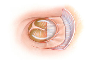 After drainage of the cyst, the infracochlear opening remains open and is marsupialized into the tympanic cavity. As the tympanomeatal flap is now too short to cover the hypotympanic defect, it is augmented with a temporalis fascia graft. Once healing has taken place, the otoscopic appearance is of an enlarged tympanic membrane.