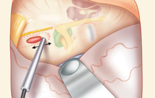 The intrapetrous carotid artery may be congenitally dehiscent on the middle fossa floor or may have been eroded by disease. A doppler probe may be useful in identifying the carotid before making incision in the roof of the cholesterol granuloma.
