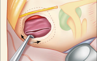 The wall of the cholesterol granuloma is dissected from its bony cavity.