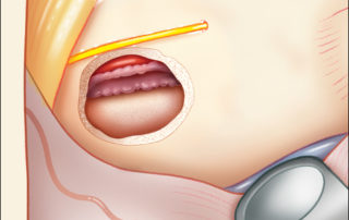 If the cyst membrane is adherent to a dehiscent vessel wall, a portion of the cyst capsule on the carotid artery to avoid possible vascular injury with resultant stroke.