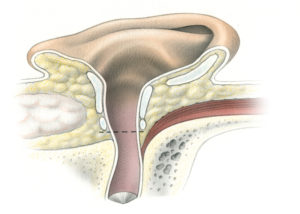 The goal of ear canal closure during skull base surgery is to create a sealed cavity into which an adipose tissue graft or muscle flap can be placed. Prior to obliterating the surgical defect, all skin and as much mucous membrane as possible must be removed from the defect. When the dura has been violated, it is essential that the closure be watertight to avoid cerebrospinal fluid leakage. This requires a multiple layer closure and meticulous technique. It is usually done in the early stages of the procedure, although it can be accomplished at any convenient stage. The ear canal is initially transected at the level of the bony cartilage junction (dashed line). For the technique of meatal closure employed in temporal bone resection for carcinoma of the ear canal, please see Chapter 5.
