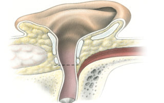 The goal of ear canal closure during skull base surgery is to create a sealed cavity into which an adipose tissue graft or muscle flap can be placed. Prior to obliterating the surgical defect, all skin and as much mucous membrane as possible must be removed from the defect. When the dura has been violated, it is essential that the closure be watertight to avoid cerebrospinal fluid leakage. This requires a multiple layer closure and meticulous technique. It is usually done in the early stages of the procedure, although it can be accomplished at any convenient stage. The ear canal is initially transected at the level of the bony cartilage junction (dashed line). For the technique of meatal closure employed in temporal bone resection for carcinoma of the ear canal, please see Chapter 5.