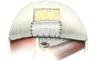 The suture line anterior to the ear canal is anchored in the parotid fascia. As this layer has little strength, this line of sutures is laid in as a row and then tied gently by hand. During the rest of the procedure (tumor exposure and resection) care must be taken with the positioning of retractors so as not to disrupt this inner surface of the meatal closure.