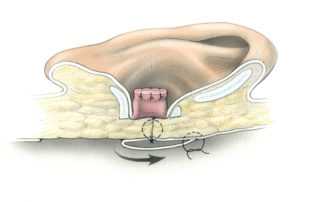 Completed meatal closure involves three layers: 1, the everted meatal skin, 2, an inner periosteal-fascial flap, and 3, intervening fibrous tissue. Of the three, the middle layer is often least substantial.