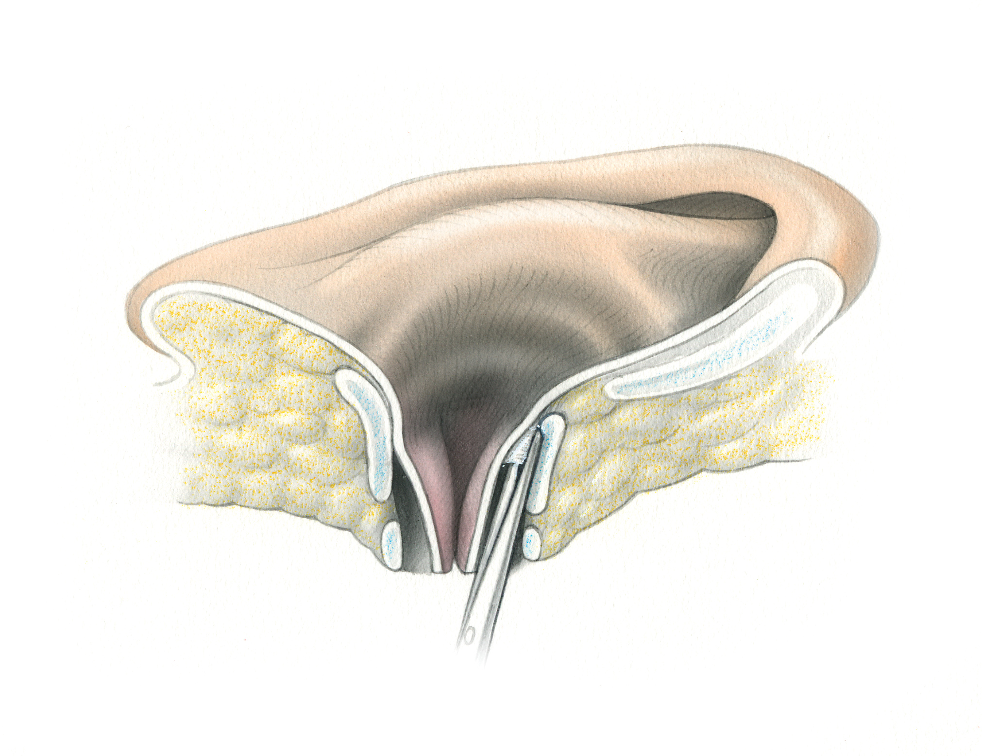 Ear Canal Closure in Skull Base Surgery – Skull Base Surgery Atlas