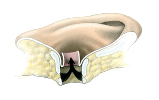 The canal skin is then inverted outward with traction sutures anchored in the subcutaneous tissue at the 12- and 6-o’clock positions.